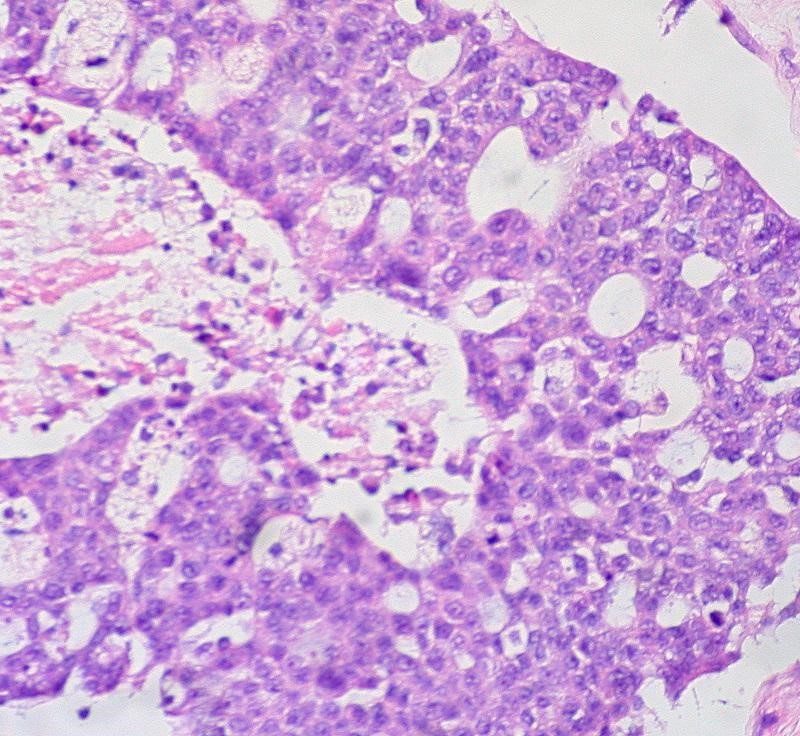 Utilizing Single Cell RNA Sequencing to Target Ovarian Cancer