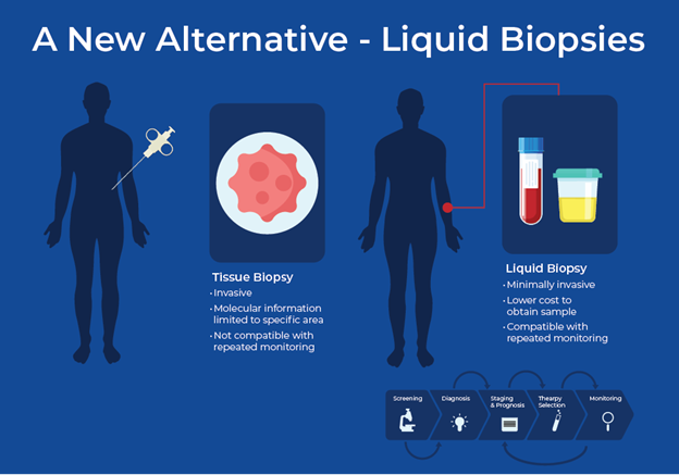 Liquid biopsies as a tool to combat prostate cancer